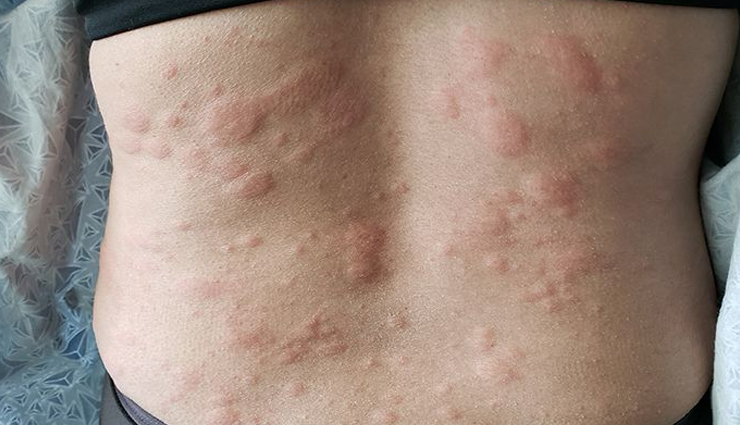 rashes,types of rashes,rashes on body