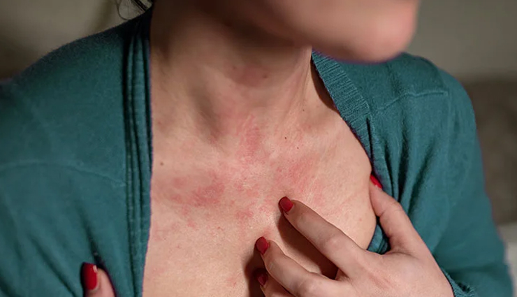  8 Home Remedies to Get Rid of Hives Naturally