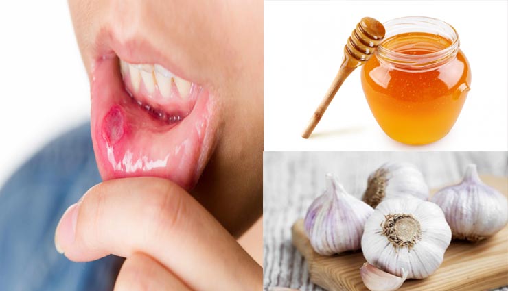 Health tips,health tips in hindi,home remedies,blisters in the mouth,home remedies to relieve the blisters in the mouth