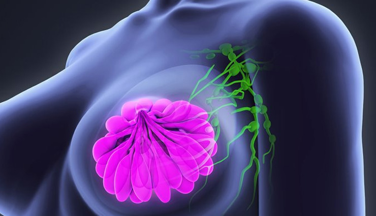 World Cancer Day 2019: ब्रेस्ट कैंसर में महिलाओं की मदद करेंगे ये घरेलू उपाय, मिलेगा फायदा 