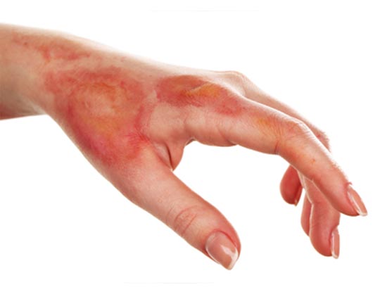 Treat Day to Day Burns With These Home Remedies