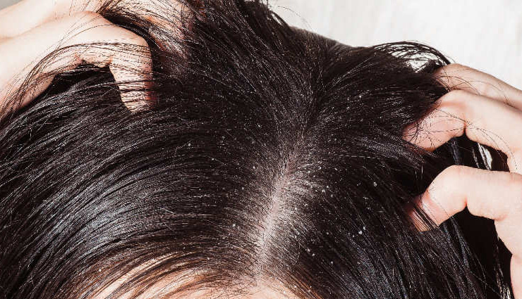 get rid of dandruff,home remedies,home remedies for dandruff,hair care tips,beauty tips