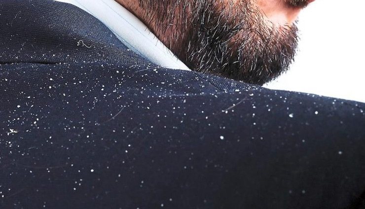 get rid of dandruff,home remedies,home remedies for dandruff,hair care tips,beauty tips