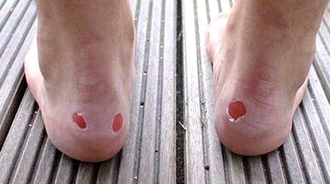 foot blisters,home remedies,Health tips,simple health tips ,घरेलू नुस्खे,बारिश,हेल्थ,हेल्थ टिप्स