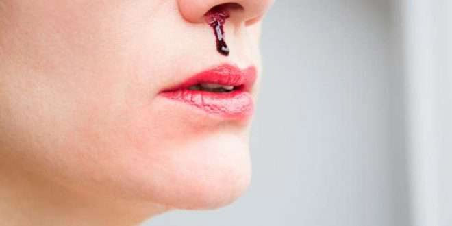 home remedies to treat naksir,home remedies,Health tips