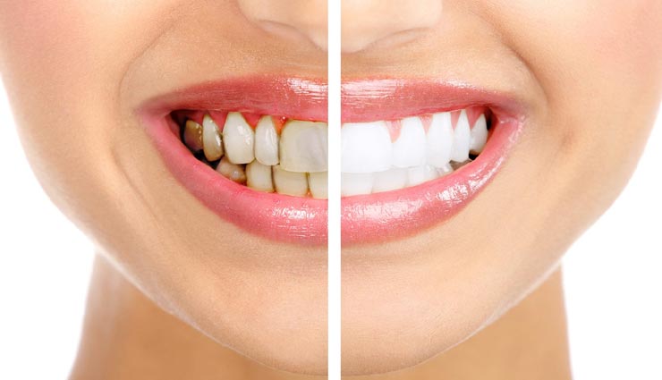 पायरिया से राहत दिलाएंगे ये देसी नुस्खें, आजमाए और दूर करे परेशानी