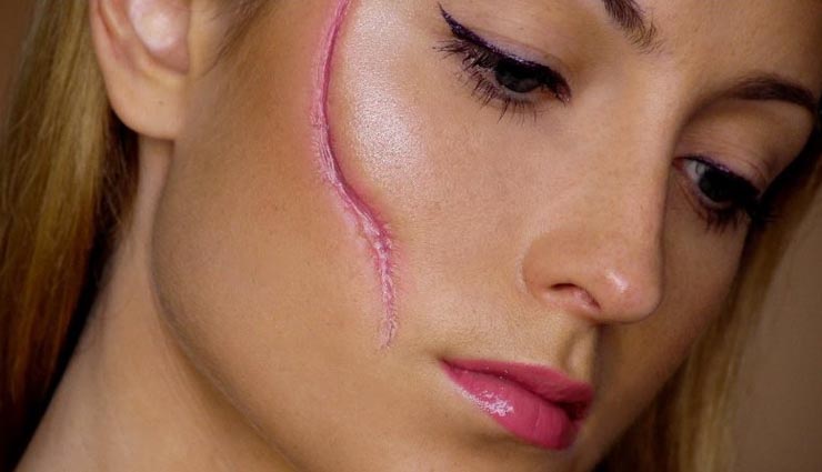 5 home remedies to get rid of scars,scars,beauty,beauty tips,cucumber,frankincense oil,rosehip seed oil,apple cider vinegar,lemon juice