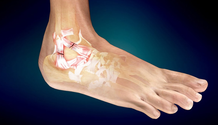 home remedies,sprain