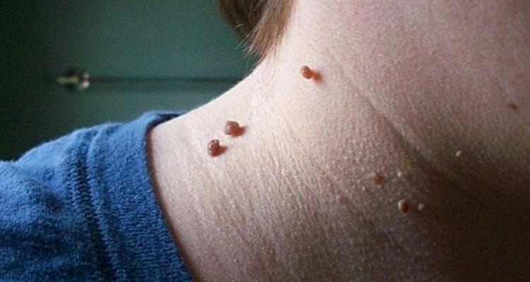 home remedies,home remedies for warts,warts
