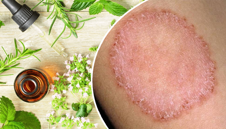 एक प्रकार का फंगल संक्रमण है दाद, निजात पाने के लिए आजमाएं ये घरेलू उपचार