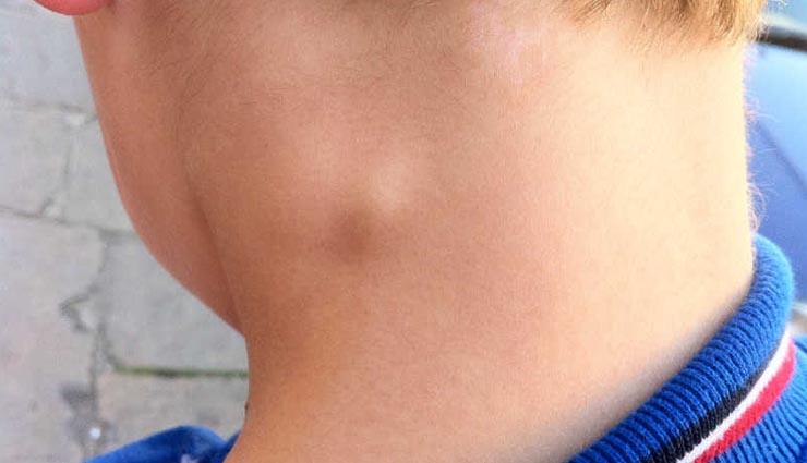 हेल्थ टिप्स : शरीर में होने वाली हर प्रकार की गांठ के घरेलू उपाय tumor,home remedies,Health tips,healthy living