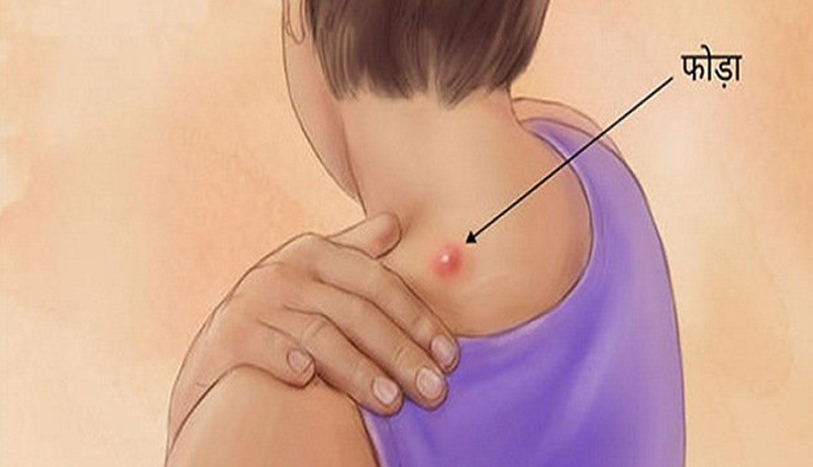 बालतोड़ का इलाज करें इन घरेलू उपायों से 