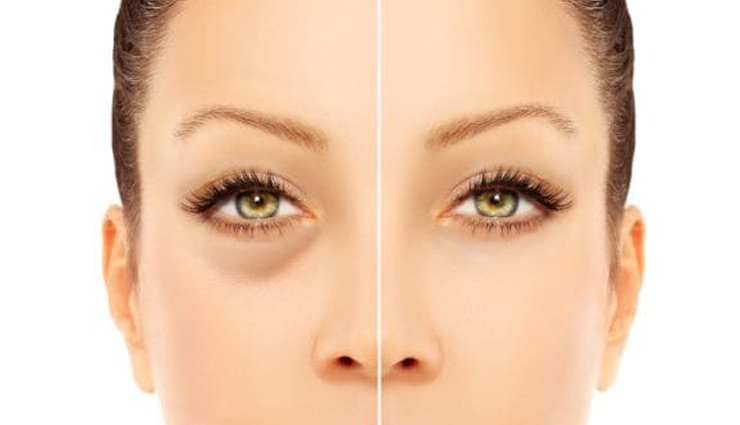 चाँद पर दाग की तरह दिखते है आँखों के नीचे काले घेरे, इन्हें हटाने के लिए करें ये उपाय