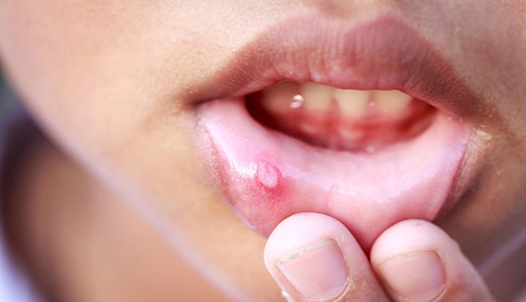tips to get rid of blisters,tips to get rid of lip pimples,pimpels on lips,skin care tips,Health tips,healthy living