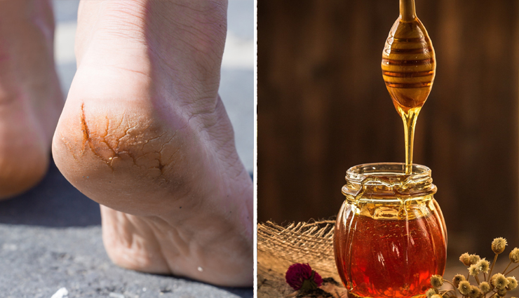 treat cracked heels at home,cracked heels,cracked heels remedies,feet,beauty,beauty tips
