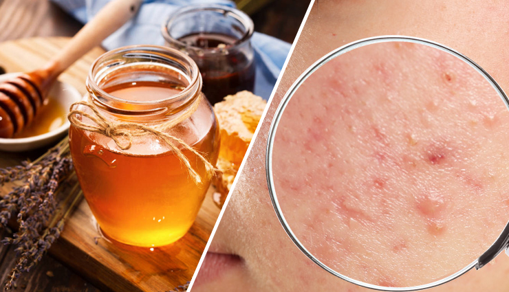 7 DIY Ways To Use Honey To Treat Acne