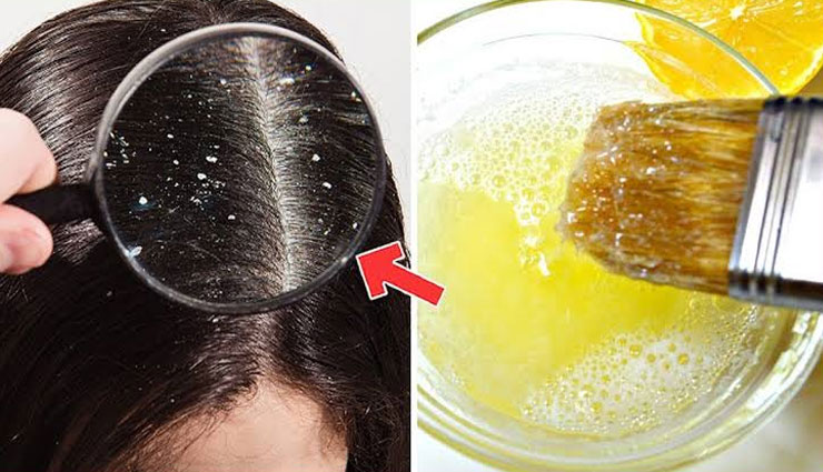 dry scalp,dry scalp treatment,remedies for dry scalp,remedies to treat dry scalp,dry scalp massage,hair massage benefits,warm oil massage,aloe vera hair massage,honey mask hair,yogurt benefits for hair,apple cider vinegar for hair,beauty,beauty tips