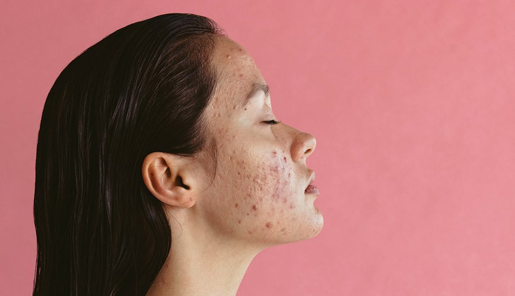 5 Ways To Treat Hormonal Imbalance Naturally