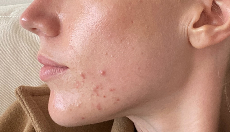 hormonal acne,causes,treat,foods to avoid,acne treatment,hormonal skin issues,skincare,hormonal imbalance,natural remedies for acne,acne-prone skin