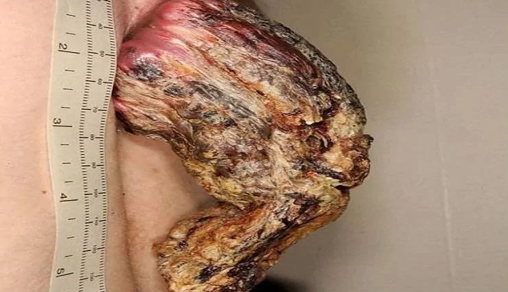 इस शख्स  की पीठ पर उग गया था सिंग, डॉक्टरों ने किया चेक तो उड़े होश, निकली ये बीमारी