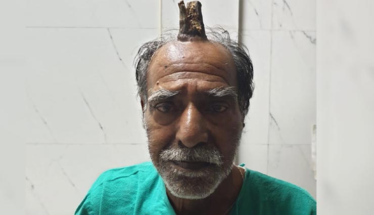 OMG! जब इंसान के सिर पर निकल आया जानवरों जैसा 'सींग', मामला देख डॉक्टर के उड़े होश