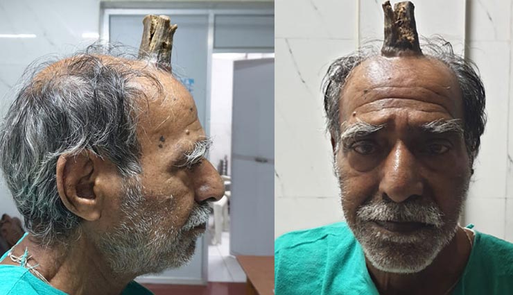 OMG! जब इंसान के सिर पर निकल आया जानवरों जैसा 'सींग', मामला देख डॉक्टर के उड़े होश sagar,madhya pradesh,zara hatke,horn,odd news,horn on human head,weird news in hindi