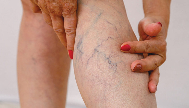 health benefits of horse chestnut,horse chestnut,Health tips,fitness tips