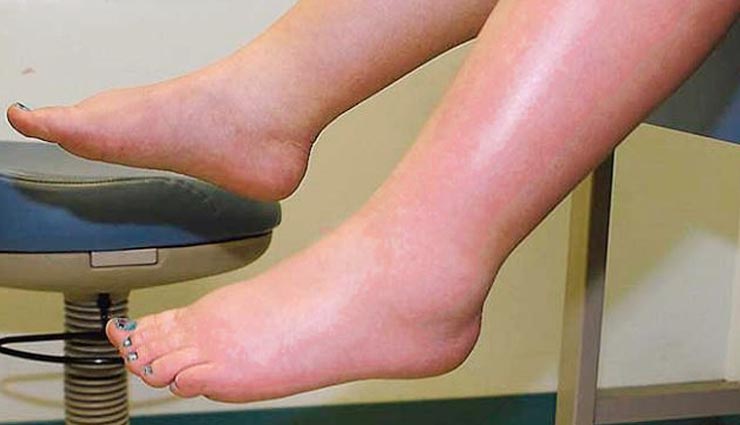 Health tips,swelling,home remedies body swelling,swollen feet