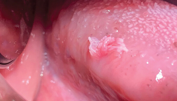 आम बात है मुँह का कैंसर होना, समय रहते किए गए इलाज से बचाया जा सकता है स्वयं को mouth cancer causes,oral cancer risk factors,tobacco and mouth cancer,alcohol and oral cancer,hpv and mouth cancer,sun exposure and lip cancer,unhealthy diet and mouth cancer,chewing tobacco and oral cancer,mouth cancer prevention,oral health and cancer development