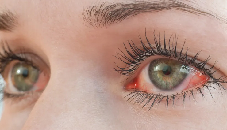 6 Remedies You Can Try To Hydrate Eyes Naturally