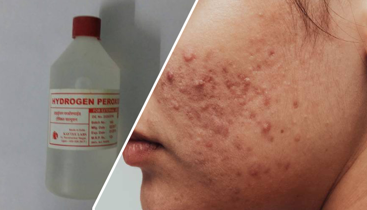 7 Amazing Benefits of Hydrogen Peroxide To Treat Acne