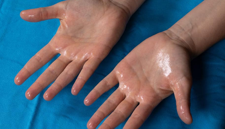 6 Must Try Remedies To Reduce Hyperhidrosis or Excess Sweating Naturally