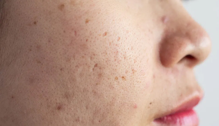 skin issues,skin treatment,food for healthy skin,skin care tips,beauty tips,beauty