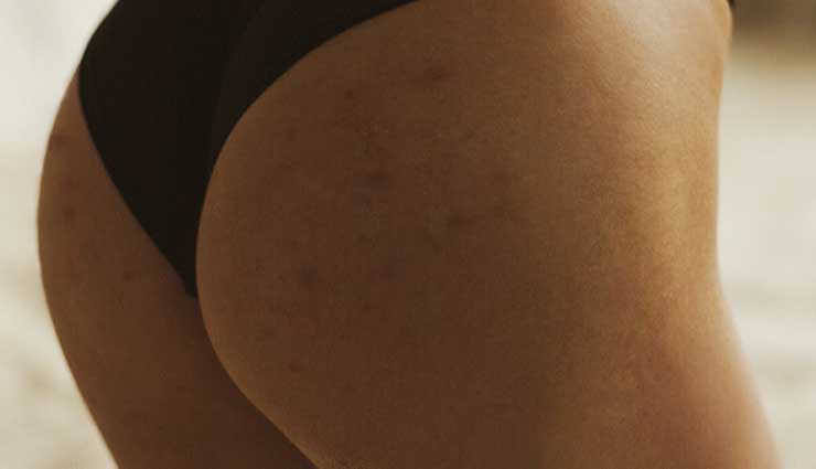 5 Effective Home Remedies For Hyperpigmentation On Buttocks
