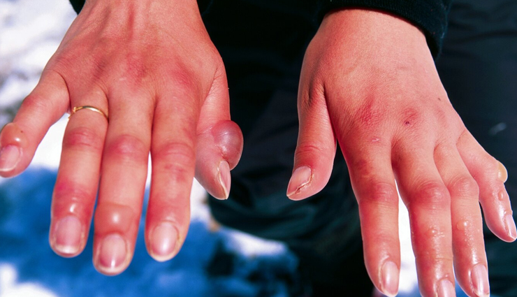 monsoon health challenges,preventing monsoon illnesses,common diseases in monsoon,health risks in rainy season,monsoon diseases prevention,monsoon health tips,waterborne diseases in monsoon,mosquito-borne illnesses monsoon,respiratory issues monsoon,monsoon skin infections,gastrointestinal problems rainy season,how to stay healthy in monsoon,monsoon safety tips