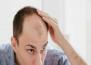 7 Home Remedies To Avoid Baldness
