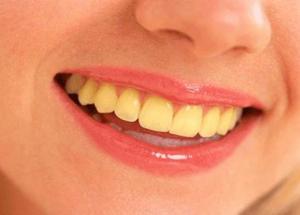 4 Tips to get rid of Yellow teeth caused by Smoking