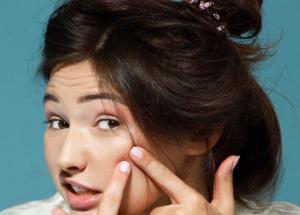 5 Easy Ways to Clear Acne