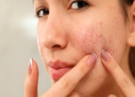 5 Things You Can Try To Treat Acne at Home