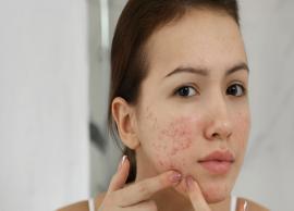 5 Steps To Get Clear Skin and Heal Acne Quickly