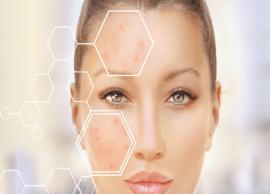 7 Effective Home Remedies To Treat Acne