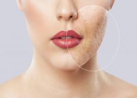 4 Ayurvedic Ways To Treat Acne