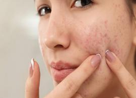 6 Remedies To Get Rid of Acne at Home