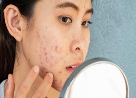 7 Effective Home Remedies To Get Rid of Acne Scars
