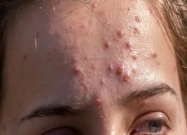 5 Methods To Help You Get Rid of Adult Acne