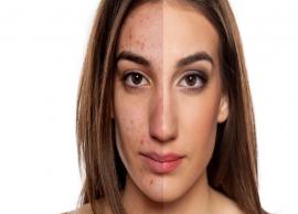 5 Home Remedies to Reduce Acne Marks