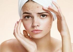 5 Best Ways To Treat Pimples Without Any Chemicals