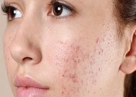 7 Home Remedies To Get Rid of Acne