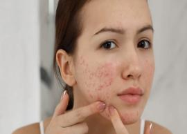 8 Unusual Reasons That Causes Acne