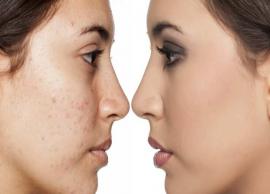 4 Home Remedies To Get Rid of Acne Scars